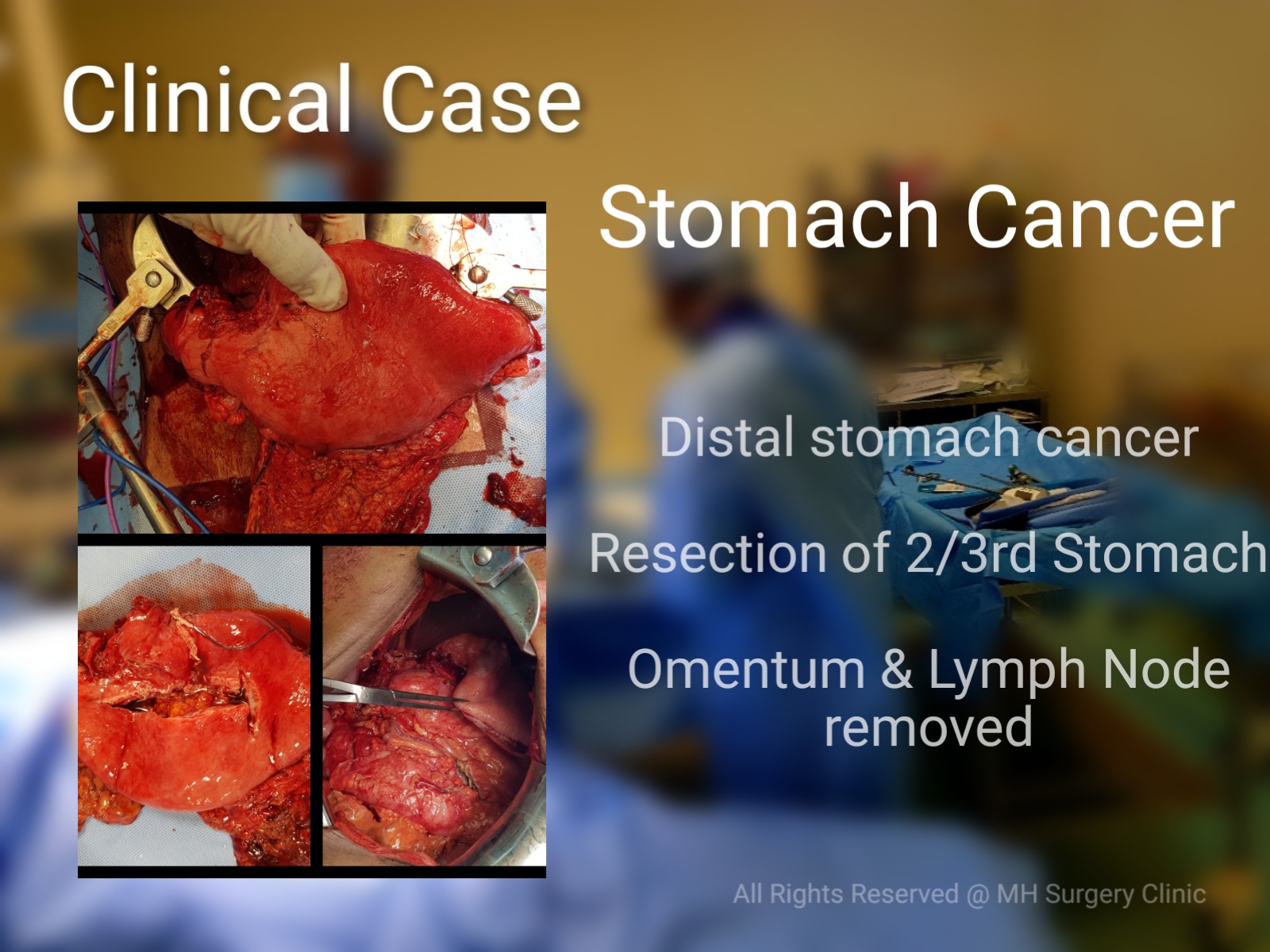 Stomach Cancer: One of the leading causes of death