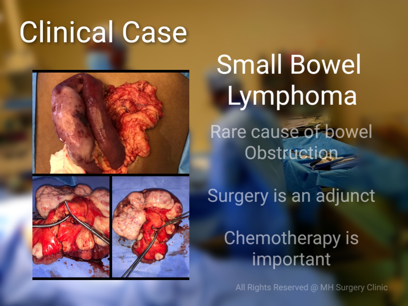 Small Bowel tumor: A rare GI malignancy 