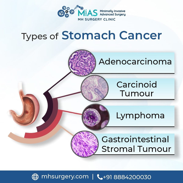 Types of stomach cancer
