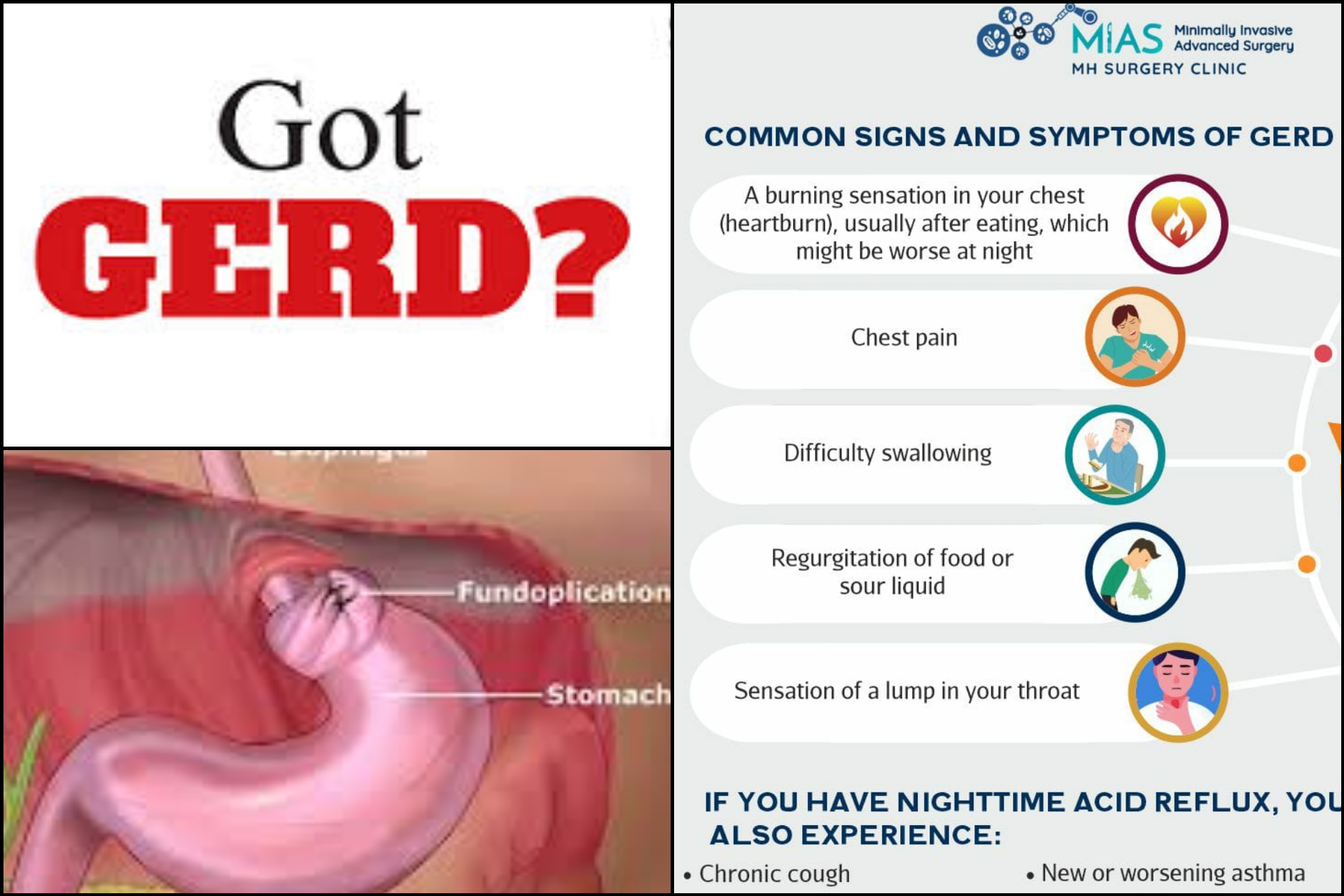 Do you have GERD?  What is GERD? What you should do ?