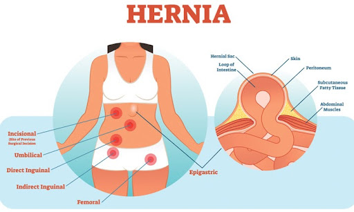 5 Signs You Need To See A Hernia Repair Specialist