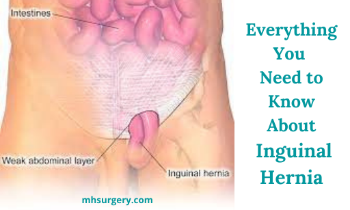 Everything You Need to Know About Inguinal Hernia